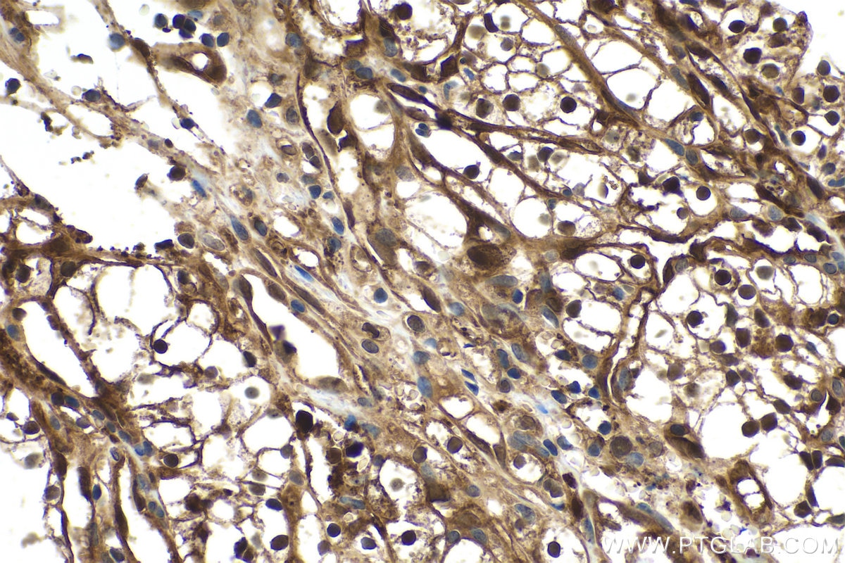 Immunohistochemical analysis of paraffin-embedded human renal cell carcinoma tissue slide using KHC0541 (IDH1 IHC Kit).
