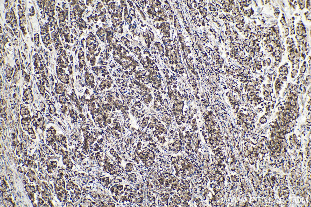 Immunohistochemical analysis of paraffin-embedded human colon cancer tissue slide using KHC0541 (IDH1 IHC Kit).
