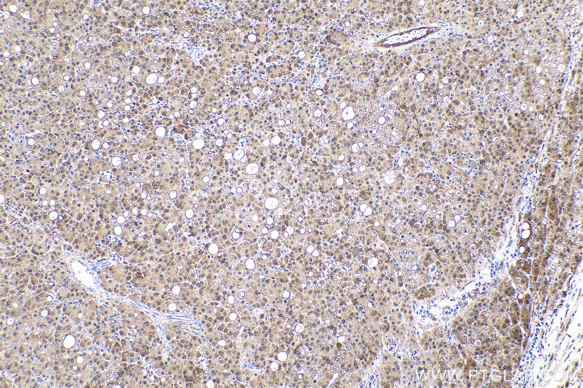 Immunohistochemical analysis of paraffin-embedded human liver cancer tissue slide using KHC0541 (IDH1 IHC Kit).