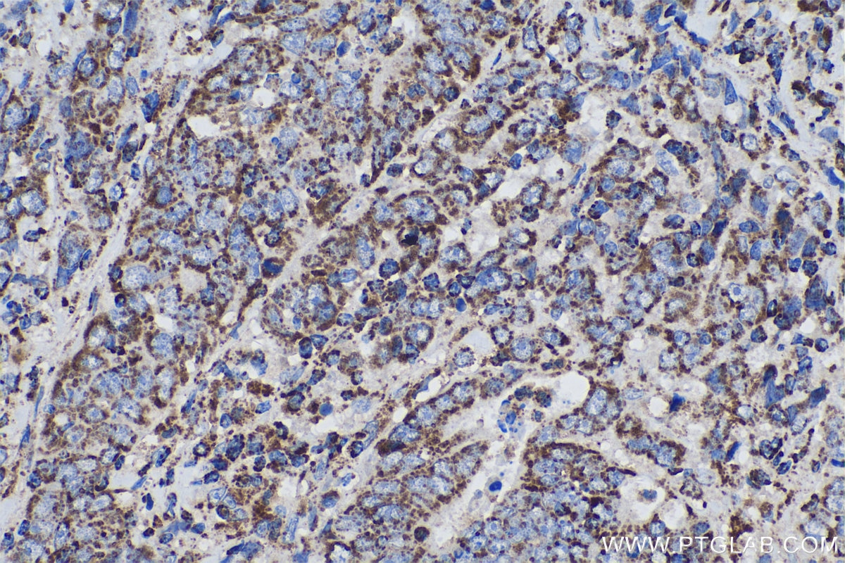 Immunohistochemical analysis of paraffin-embedded human colon cancer tissue slide using KHC0580 (IDH2 IHC Kit).