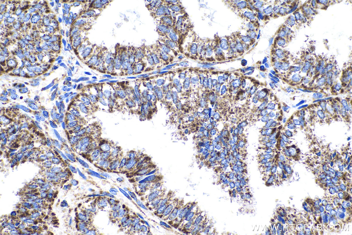 Immunohistochemical analysis of paraffin-embedded human ovary tumor tissue slide using KHC0580 (IDH2 IHC Kit).