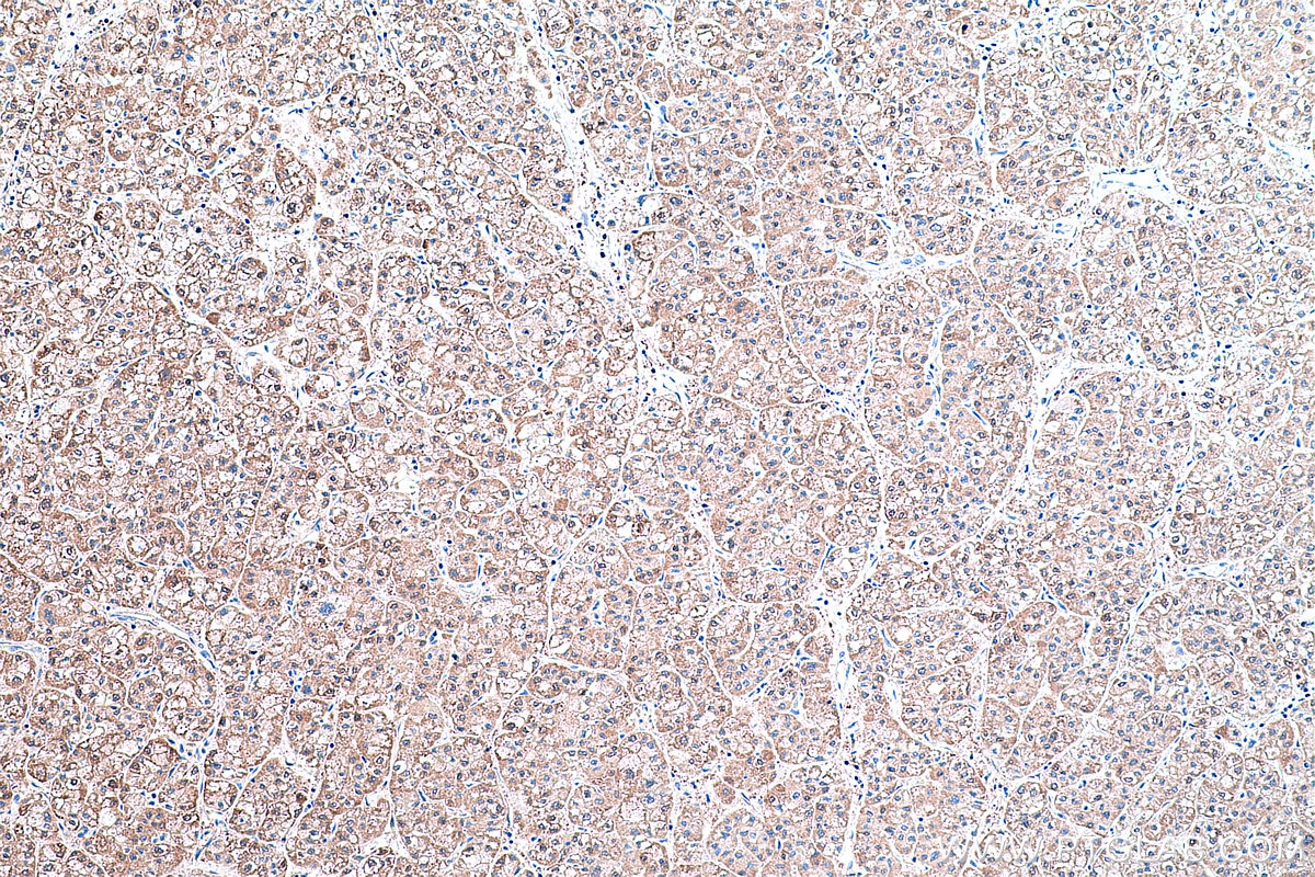 Immunohistochemical analysis of paraffin-embedded human liver cancer tissue slide using KHC0428 (IDI1 IHC Kit).