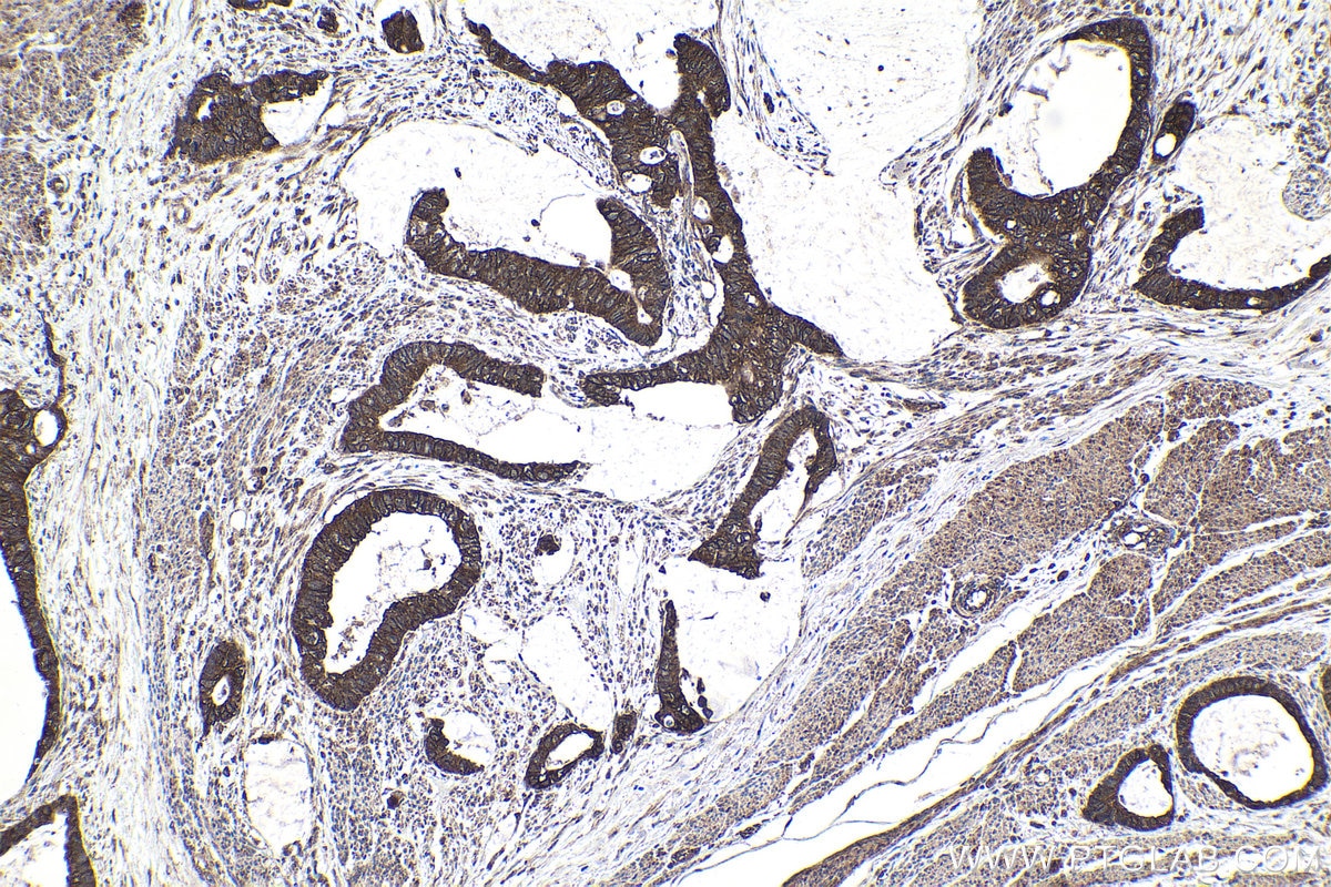 Immunohistochemical analysis of paraffin-embedded human urothelial carcinoma tissue slide using KHC1904 (IER2 IHC Kit).