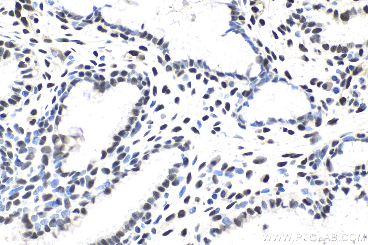 Immunohistochemical analysis of paraffin-embedded human cervical cancer tissue slide using KHC1764 (IFI16 IHC Kit).