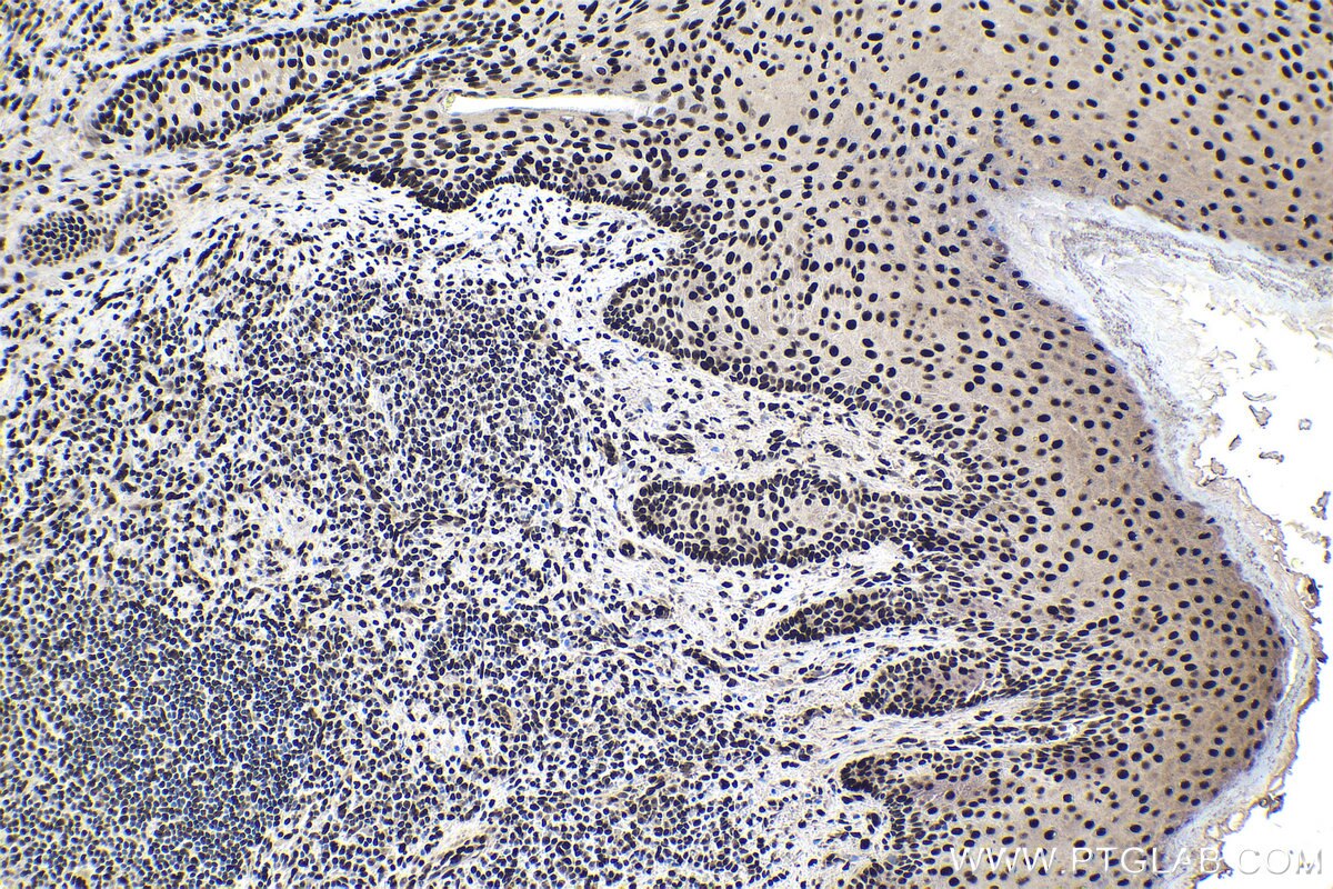 Immunohistochemical analysis of paraffin-embedded human skin cancer tissue slide using KHC1764 (IFI16 IHC Kit).