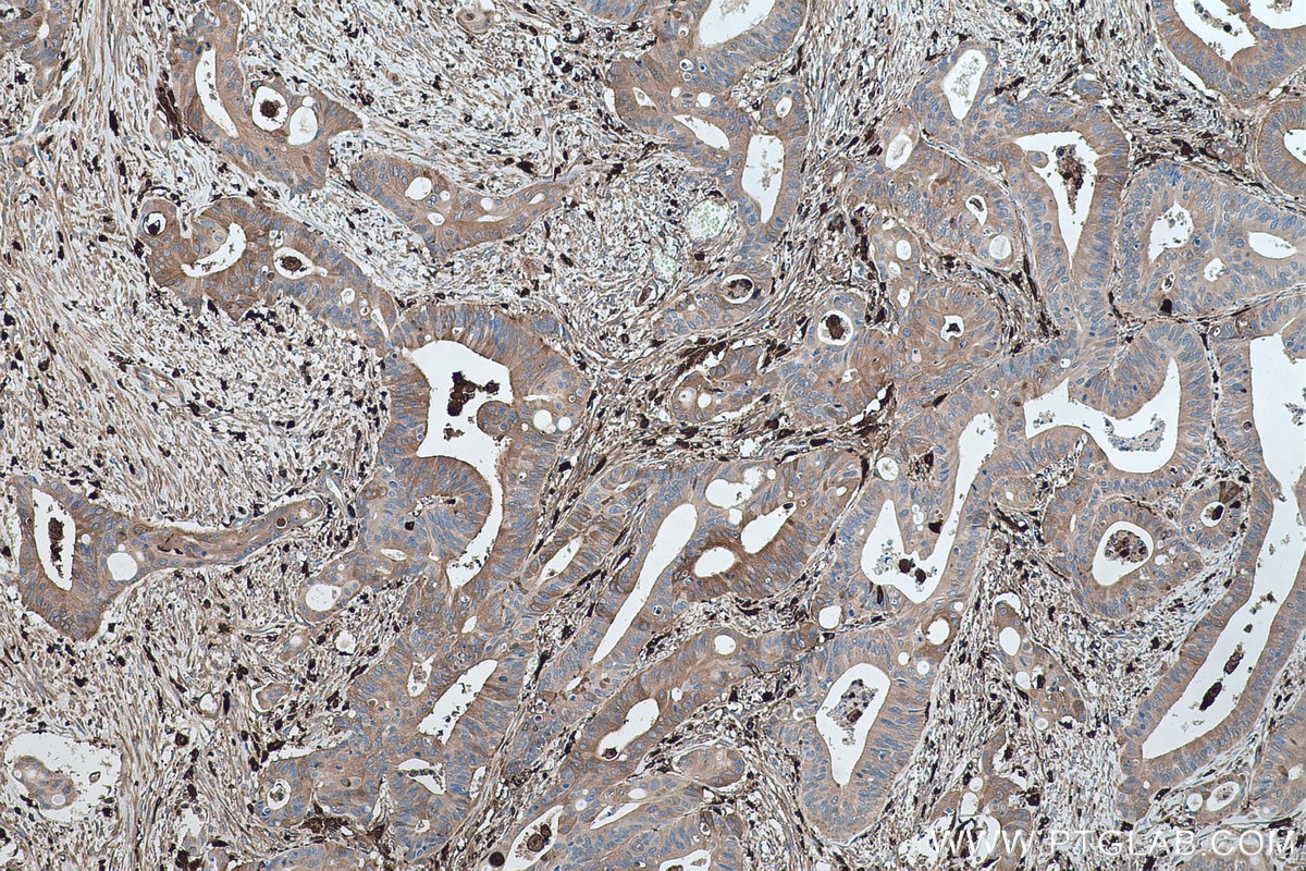 Immunohistochemical analysis of paraffin-embedded human colon cancer tissue slide using KHC0429 (IFI30 IHC Kit).