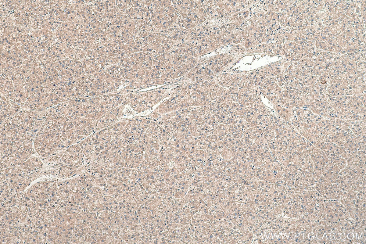 Immunohistochemical analysis of paraffin-embedded human liver cancer tissue slide using KHC0430 (IFI6/G1P3 IHC Kit).