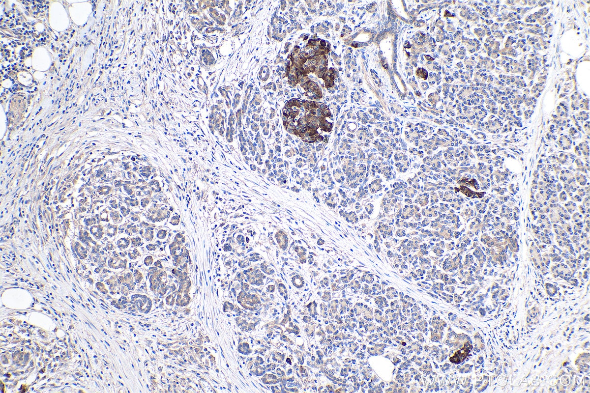 Immunohistochemical analysis of paraffin-embedded human pancreas cancer tissue slide using KHC0430 (IFI6/G1P3 IHC Kit).