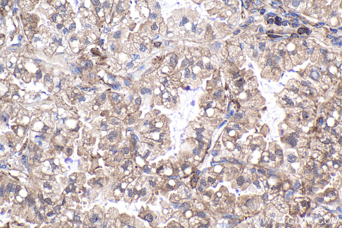Immunohistochemical analysis of paraffin-embedded human lung cancer tissue slide using KHC1910 (IFIH1 IHC Kit).