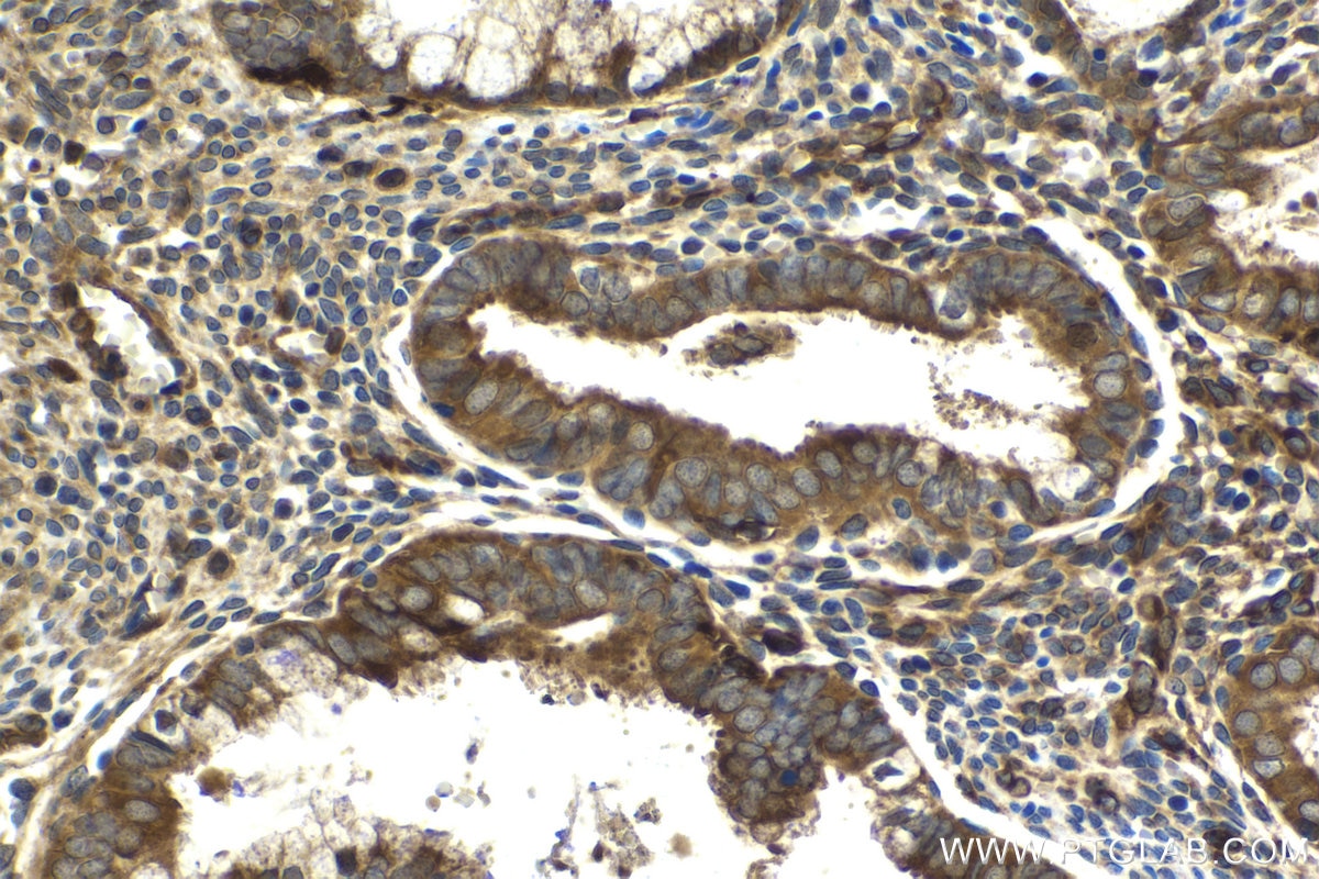 Immunohistochemical analysis of paraffin-embedded human cervical cancer tissue slide using KHC2059 (IFIT3 IHC Kit).