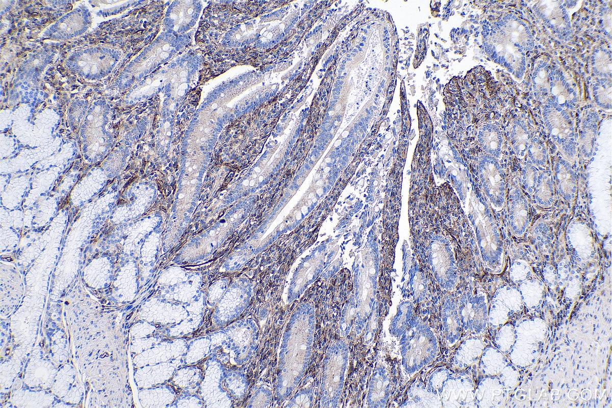 Immunohistochemical analysis of paraffin-embedded human stomach cancer tissue slide using KHC0628 (IFITM1-Specific IHC Kit).