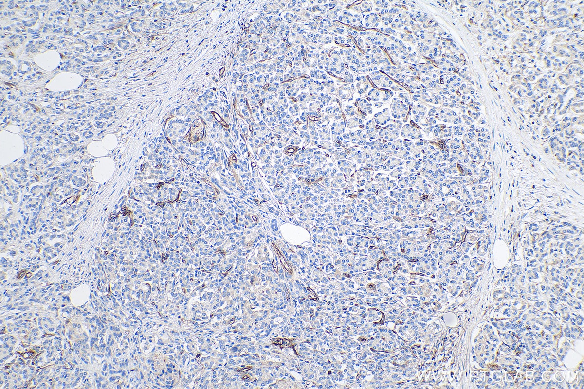 Immunohistochemical analysis of paraffin-embedded human pancreas cancer tissue slide using KHC0628 (IFITM1-Specific IHC Kit).