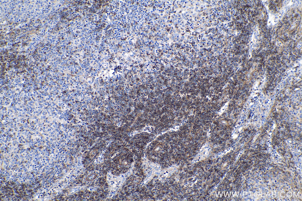 Immunohistochemical analysis of paraffin-embedded human lymphoma tissue slide using KHC0628 (IFITM1-Specific IHC Kit).