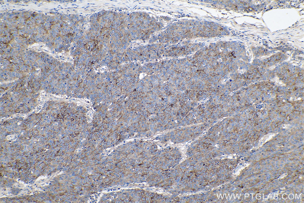 Immunohistochemical analysis of paraffin-embedded human colon cancer tissue slide using KHC0628 (IFITM1-Specific IHC Kit).