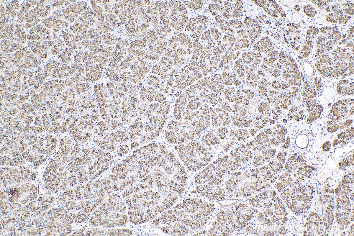Immunohistochemical analysis of paraffin-embedded human liver cancer tissue slide using KHC0431 (IFITM2/3 IHC Kit).