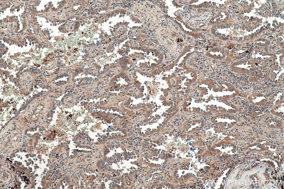 Immunohistochemical analysis of paraffin-embedded human lung cancer tissue slide using KHC0737 (IGF1R IHC Kit).