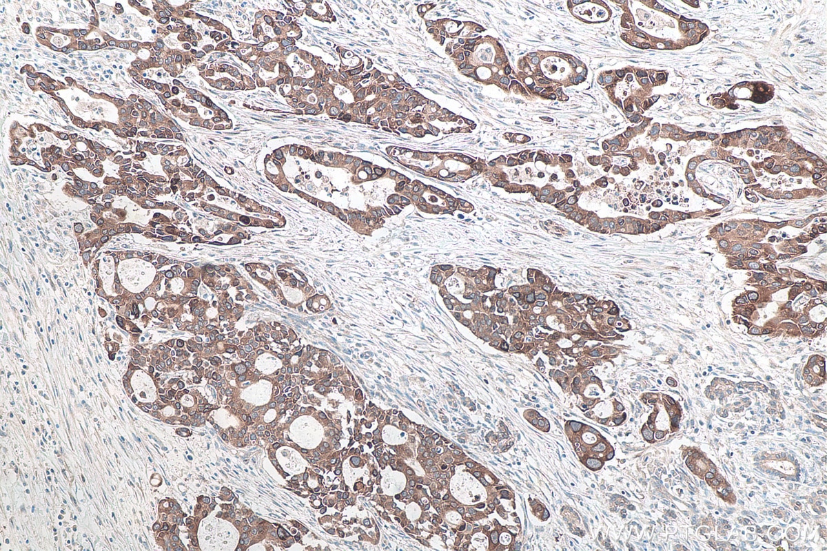 Immunohistochemical analysis of paraffin-embedded human pancreas cancer tissue slide using KHC0161 (IGF2BP2 IHC Kit).