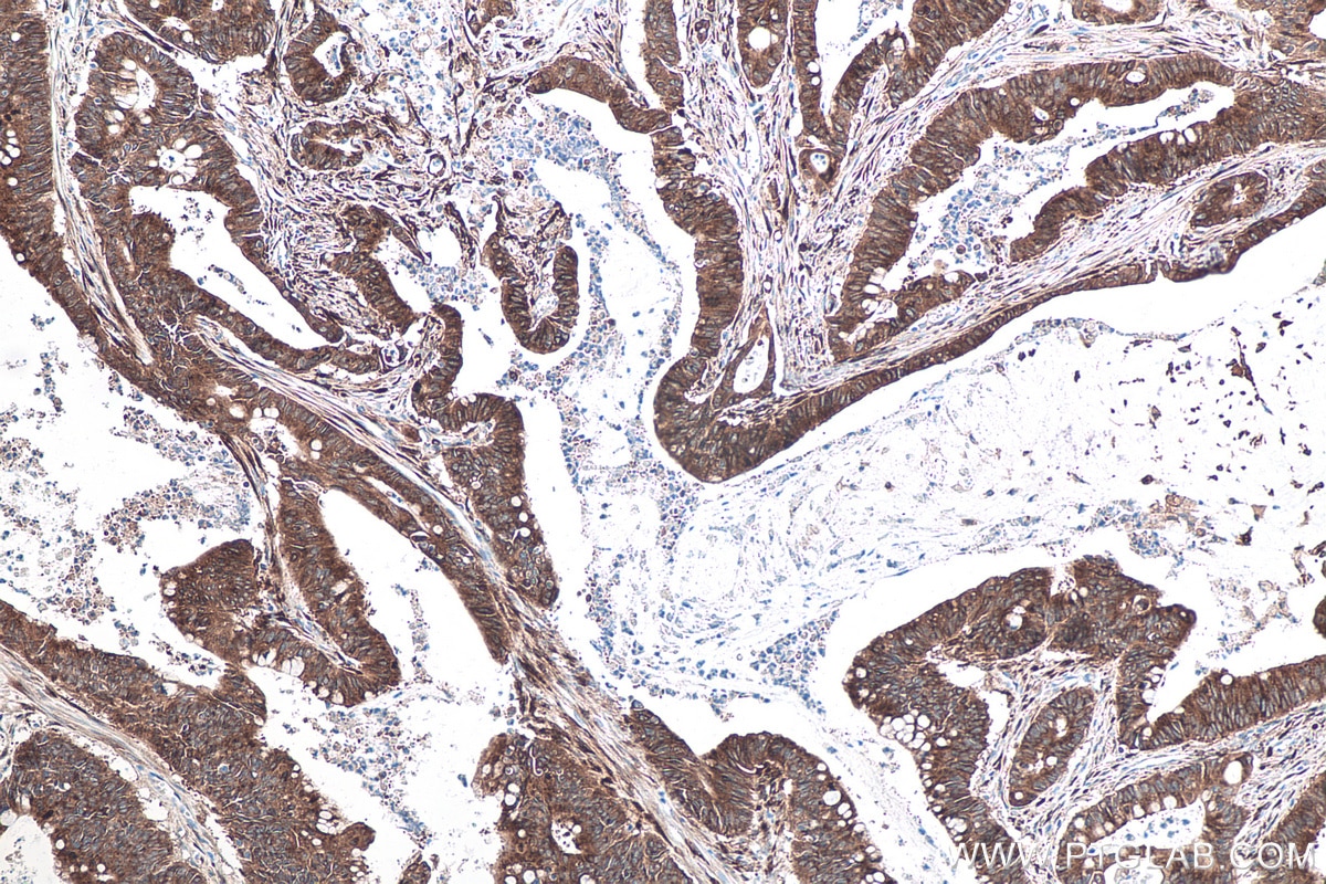 Immunohistochemical analysis of paraffin-embedded human colon cancer tissue slide using KHC0161 (IGF2BP2 IHC Kit).