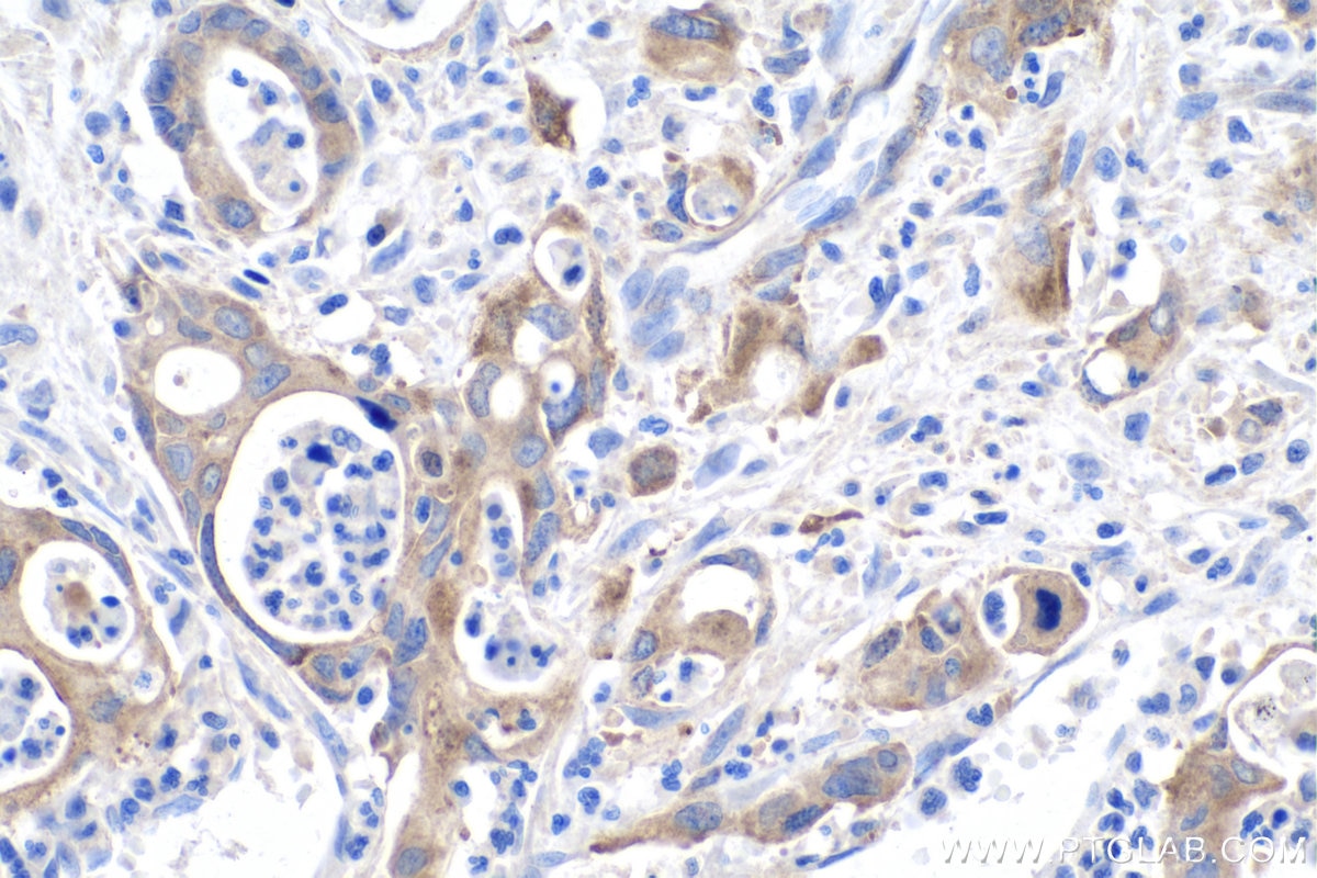 Immunohistochemical analysis of paraffin-embedded human colon cancer tissue slide using KHC0162 (IGF2BP3 IHC Kit).