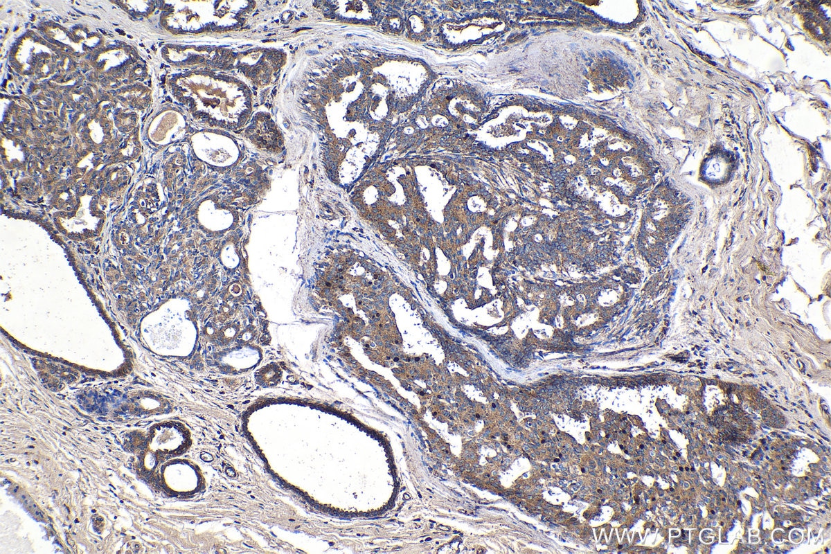 Immunohistochemical analysis of paraffin-embedded human breast cancer tissue slide using KHC1361 (IGF2R-Specific IHC Kit).