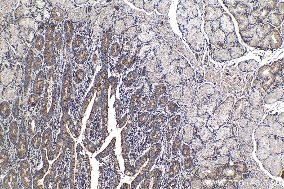 Immunohistochemical analysis of paraffin-embedded human stomach cancer tissue slide using KHC1361 (IGF2R-Specific IHC Kit).