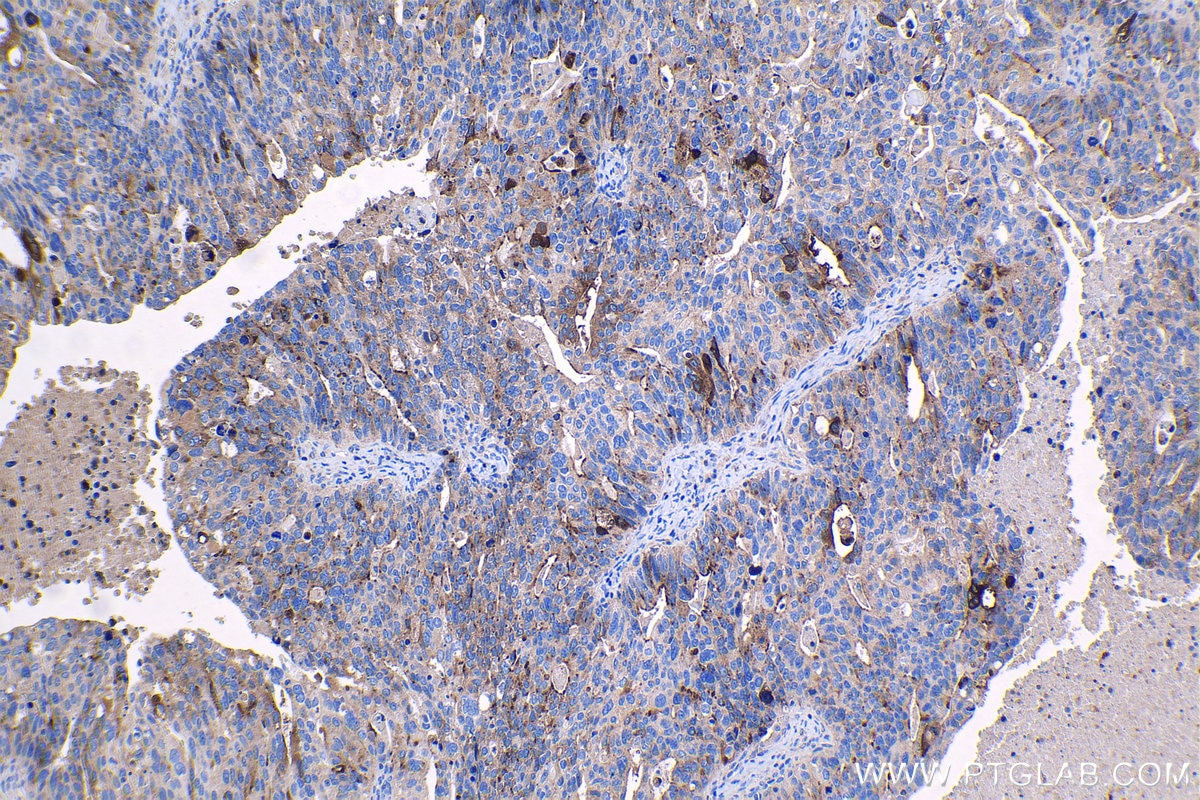 Immunohistochemical analysis of paraffin-embedded human ovary tumor tissue slide using KHC1333 (IGFBP2 IHC Kit).