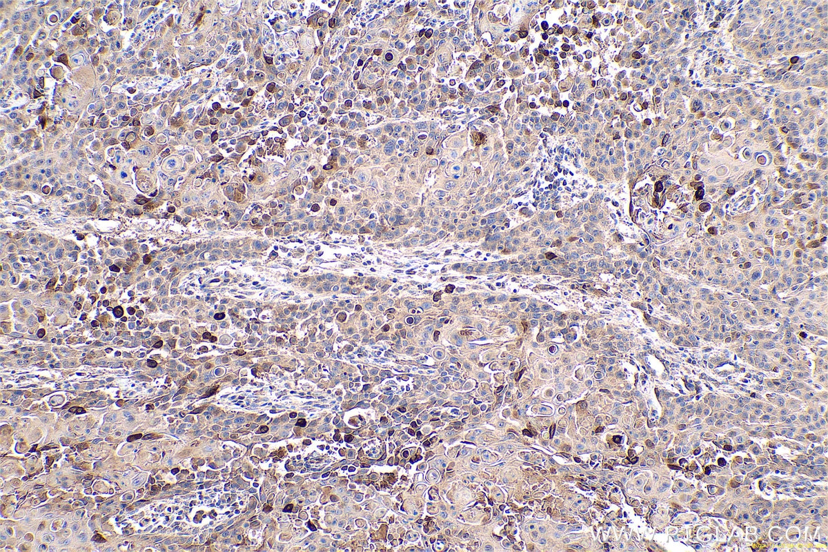 Immunohistochemical analysis of paraffin-embedded human oesophagus cancer tissue slide using KHC0629 (IGFBP3 IHC Kit).