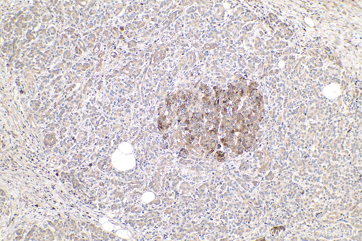 Immunohistochemical analysis of paraffin-embedded human pancreas cancer tissue slide using KHC0629 (IGFBP3 IHC Kit).