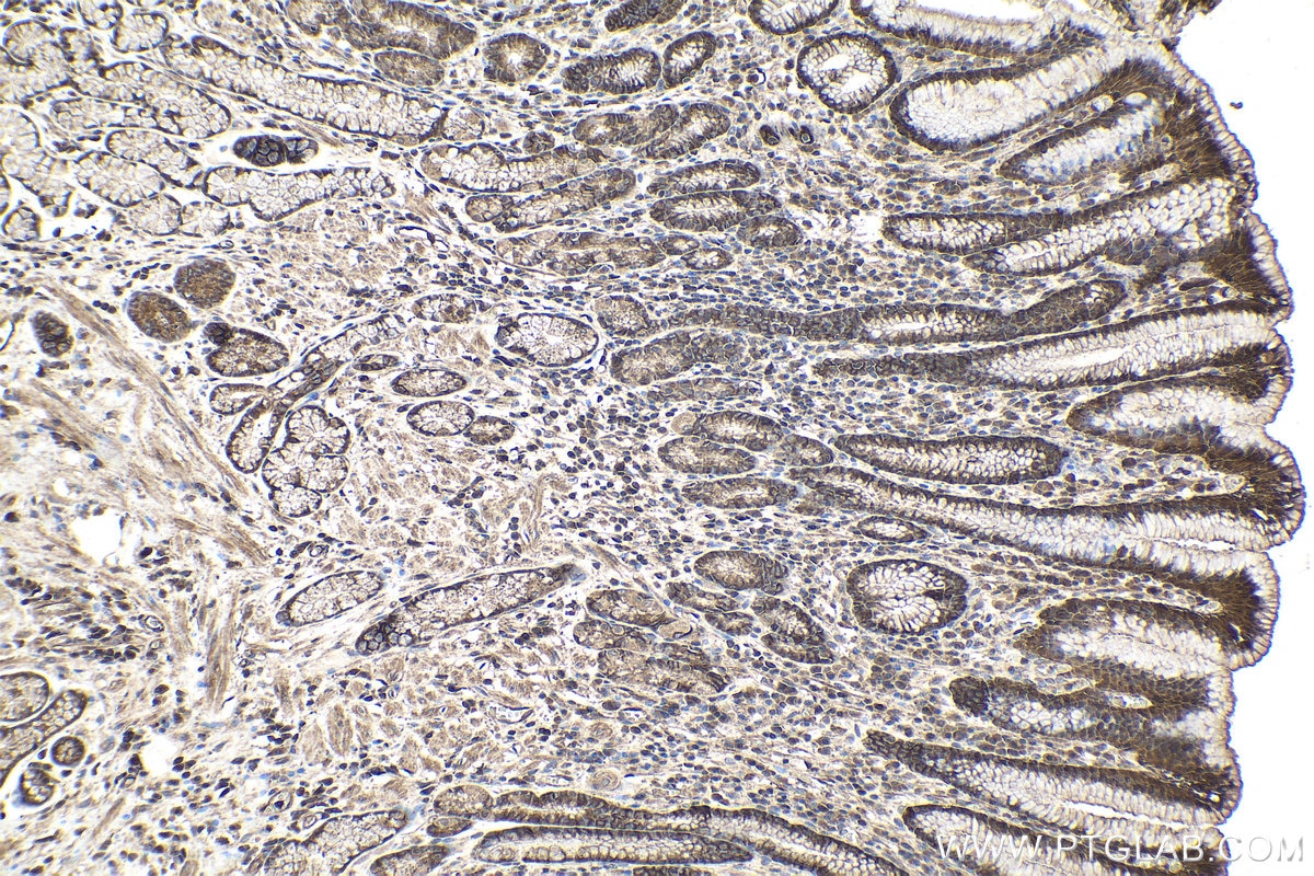 Immunohistochemical analysis of paraffin-embedded human stomach cancer tissue slide using KHC1051 (IGFBP7 IHC Kit).