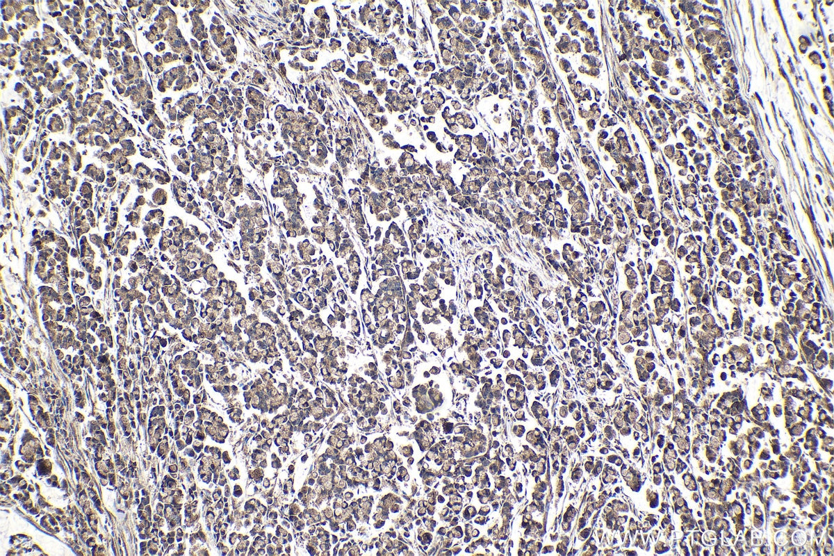 Immunohistochemical analysis of paraffin-embedded human colon cancer tissue slide using KHC1051 (IGFBP7 IHC Kit).