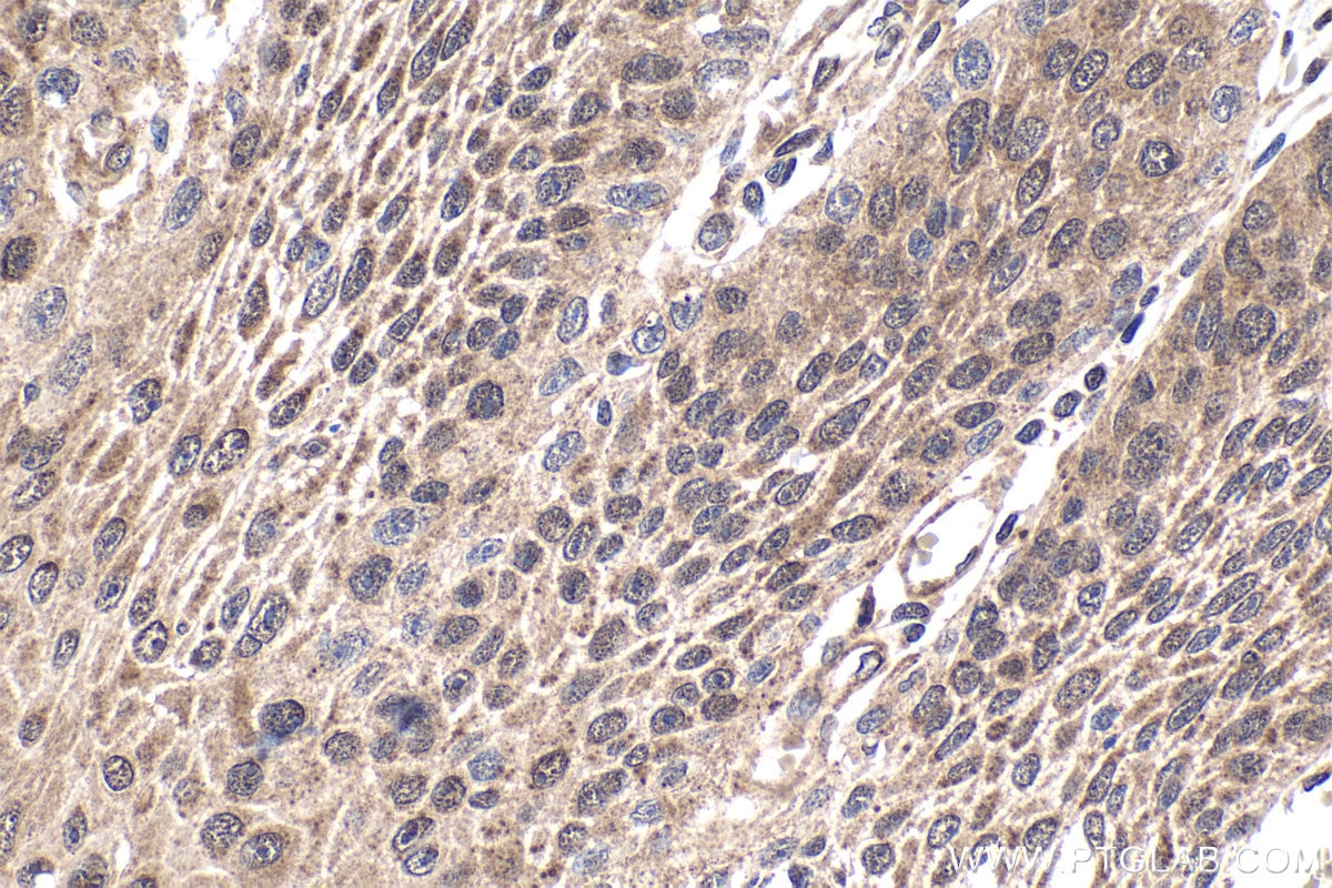Immunohistochemical analysis of paraffin-embedded human oesophagus cancer tissue slide using KHC1589 (IGHMBP2 IHC Kit).