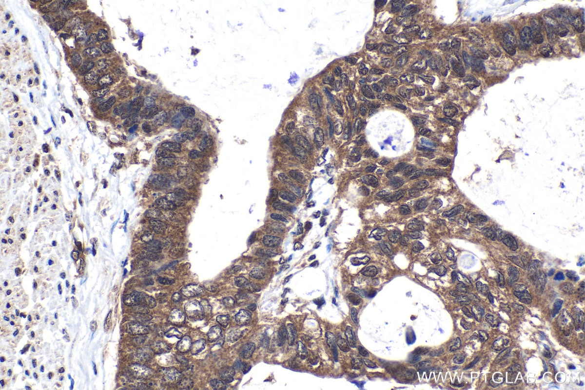 Immunohistochemical analysis of paraffin-embedded human urothelial carcinoma tissue slide using KHC1589 (IGHMBP2 IHC Kit).