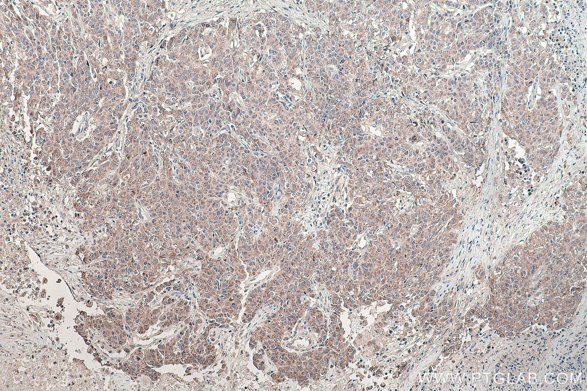 Immunohistochemical analysis of paraffin-embedded human stomach cancer tissue slide using KHC0135 (IHH IHC Kit).