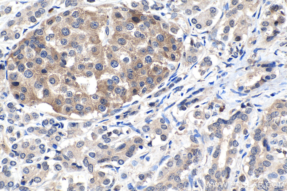 Immunohistochemical analysis of paraffin-embedded human pancreas cancer tissue slide using KHC1432 (IKBKB IHC Kit).