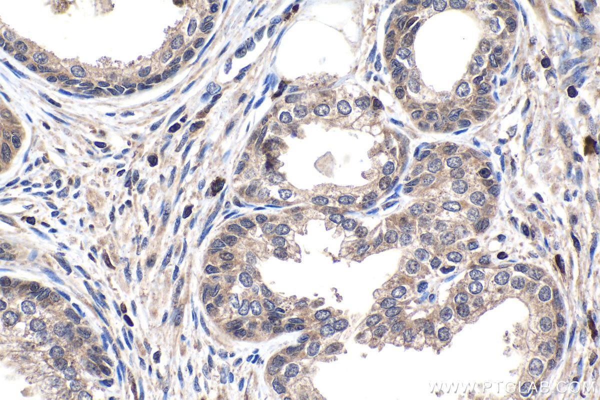 Immunohistochemical analysis of paraffin-embedded human prostate cancer tissue slide using KHC1432 (IKBKB IHC Kit).