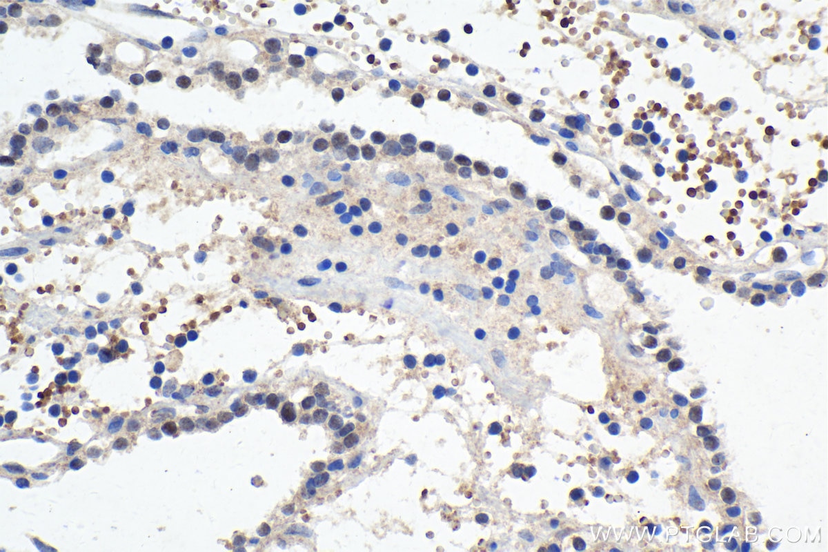 Immunohistochemical analysis of paraffin-embedded human renal cell carcinoma tissue slide using KHC1934 (IKZF5 IHC Kit).