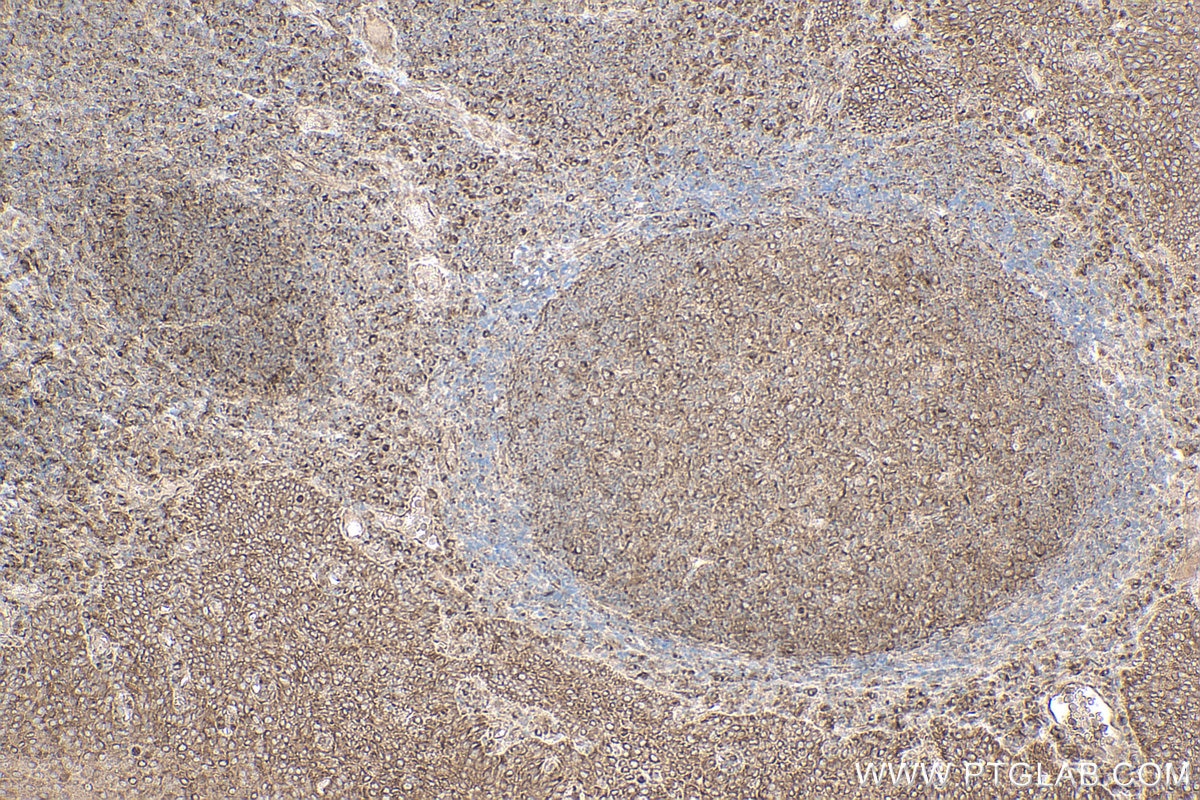 Immunohistochemical analysis of paraffin-embedded human tonsillitis tissue slide using KHC0811 (IL6ST/GP130 IHC Kit).