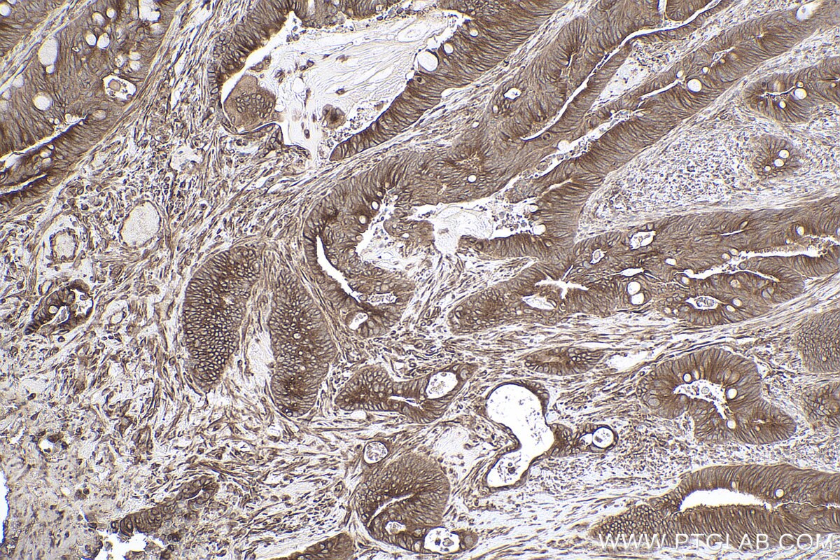 Immunohistochemical analysis of paraffin-embedded human colon cancer tissue slide using KHC0811 (IL6ST/GP130 IHC Kit).