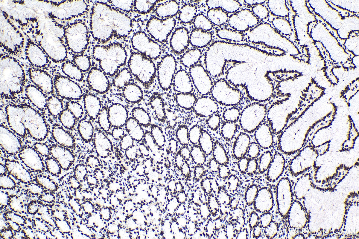 Immunohistochemical analysis of paraffin-embedded human stomach cancer tissue slide using KHC1695 (ILF3 IHC Kit).