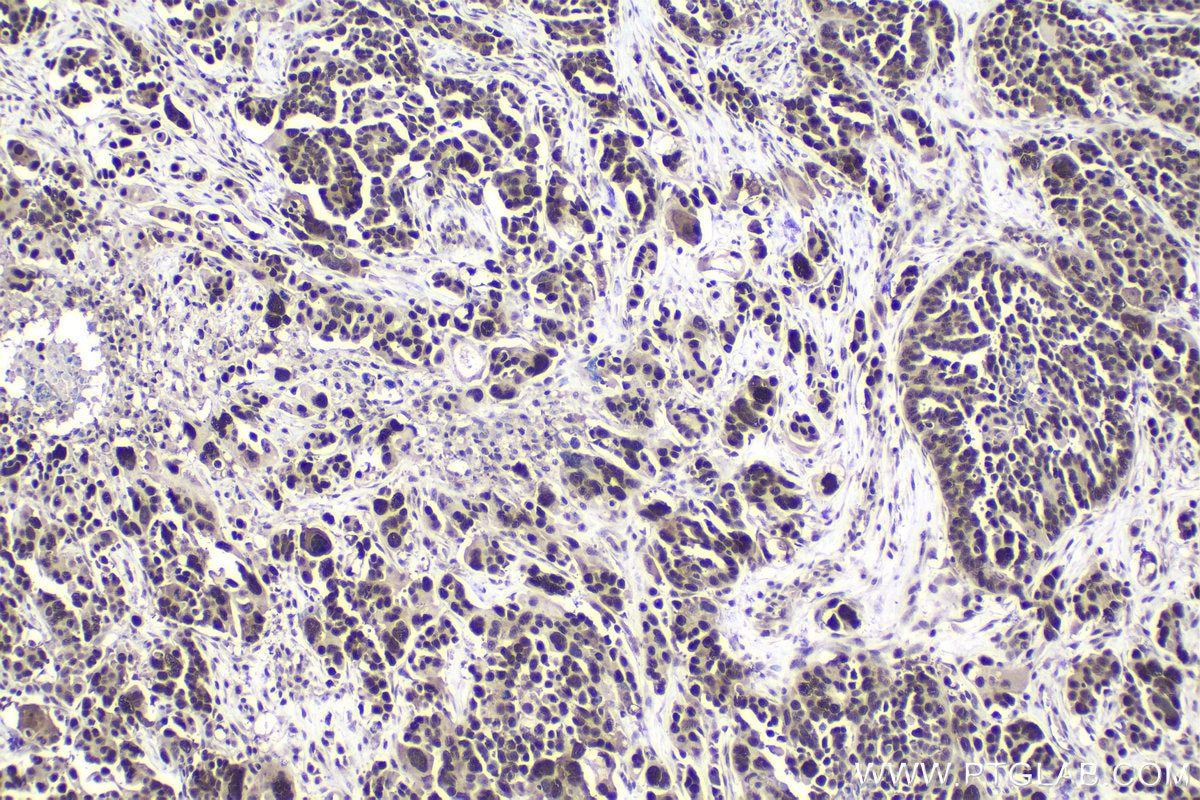 Immunohistochemical analysis of paraffin-embedded human colon cancer tissue slide using KHC1022 (ILKAP IHC Kit).