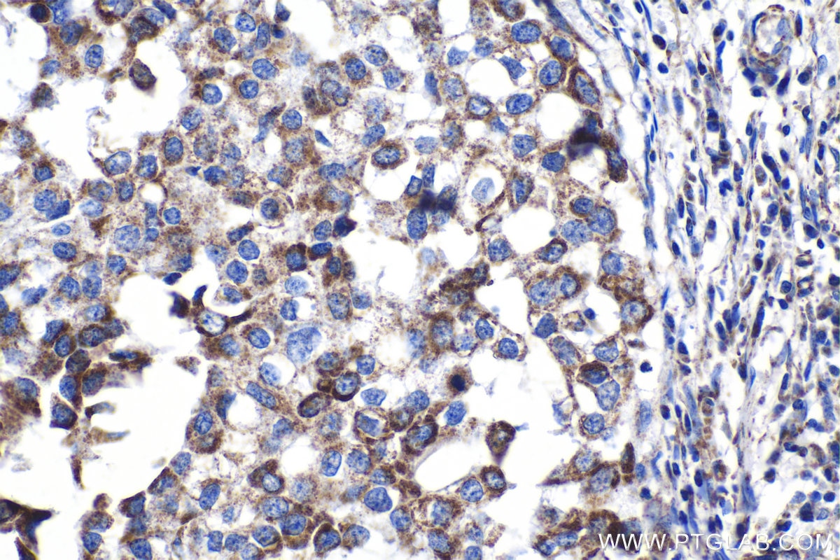 Immunohistochemical analysis of paraffin-embedded human breast cancer tissue slide using KHC1362 (IMMT IHC Kit).
