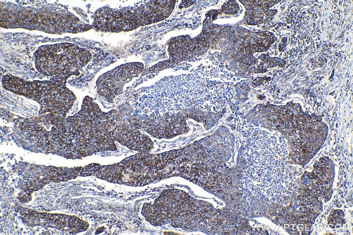 Immunohistochemical analysis of paraffin-embedded human lung cancer tissue slide using KHC1362 (IMMT IHC Kit).