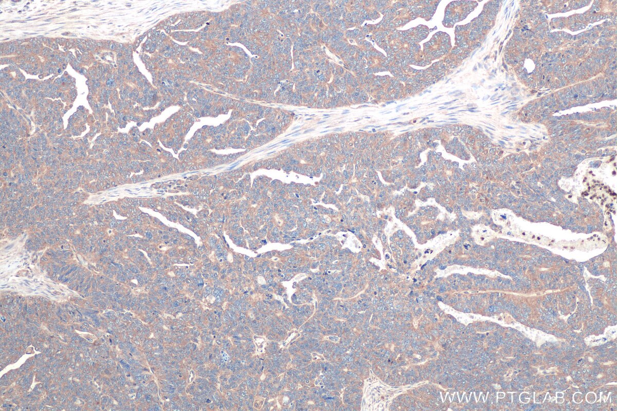 Immunohistochemical analysis of paraffin-embedded human ovary tumor tissue slide using KHC0911 (IMPDH1 IHC Kit).