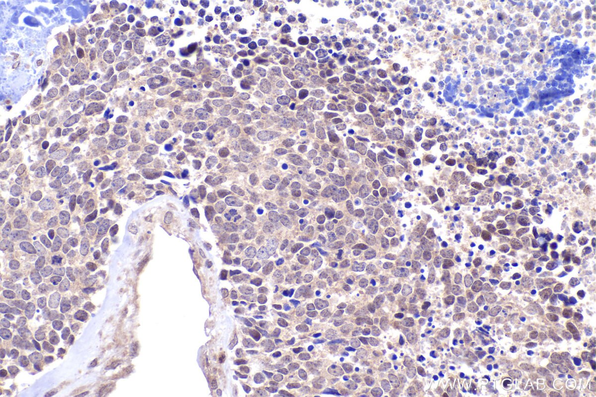 Immunohistochemical analysis of paraffin-embedded human lung cancer tissue slide using KHC2404 (INCA1 IHC Kit).
