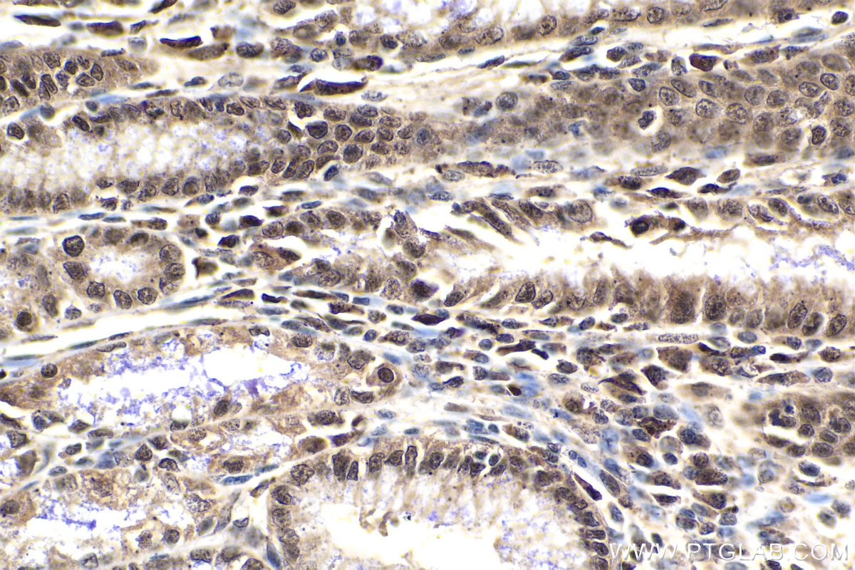 Immunohistochemical analysis of paraffin-embedded human stomach cancer tissue slide using KHC1922 (ING2 IHC Kit).