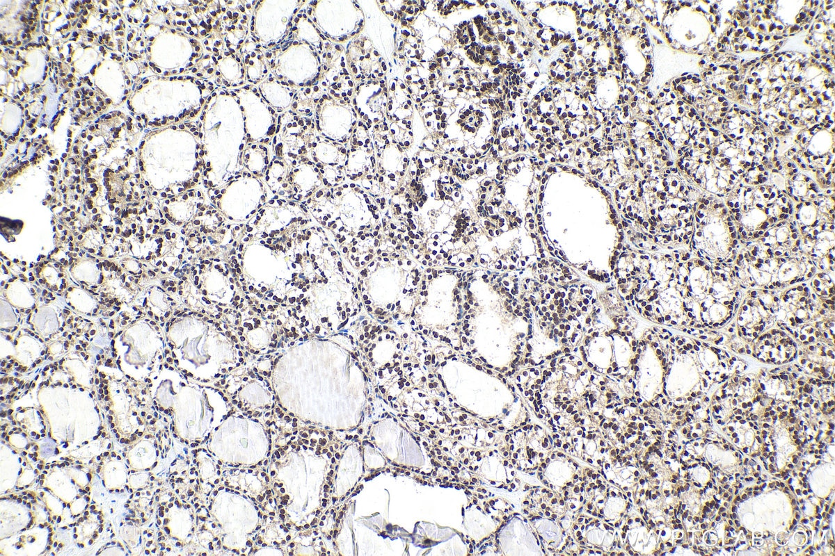Immunohistochemical analysis of paraffin-embedded human thyroid cancer tissue slide using KHC2005 (ING4 IHC Kit).