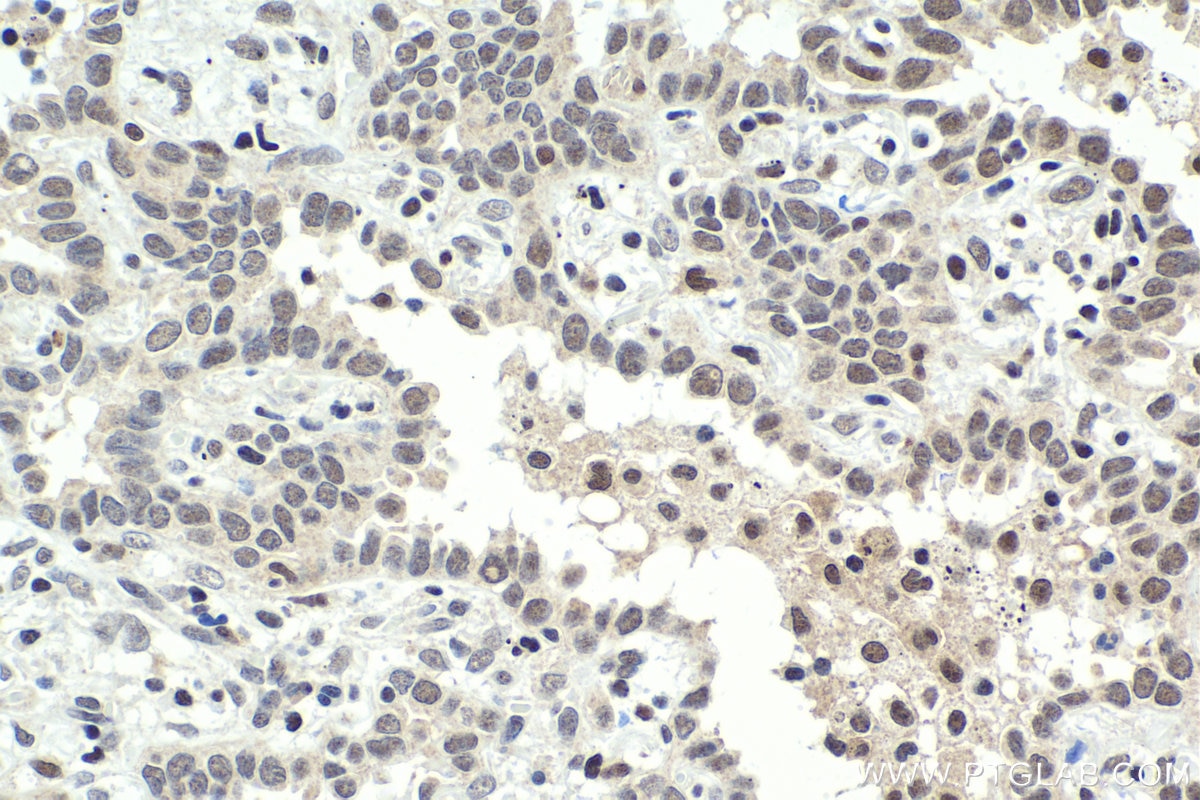 Immunohistochemical analysis of paraffin-embedded human lung cancer tissue slide using KHC1846 (ING5 IHC Kit).