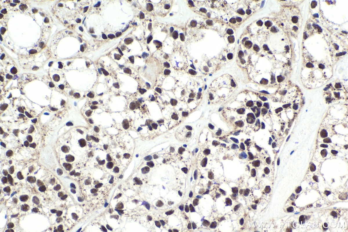 Immunohistochemical analysis of paraffin-embedded human thyroid cancer tissue slide using KHC1846 (ING5 IHC Kit).