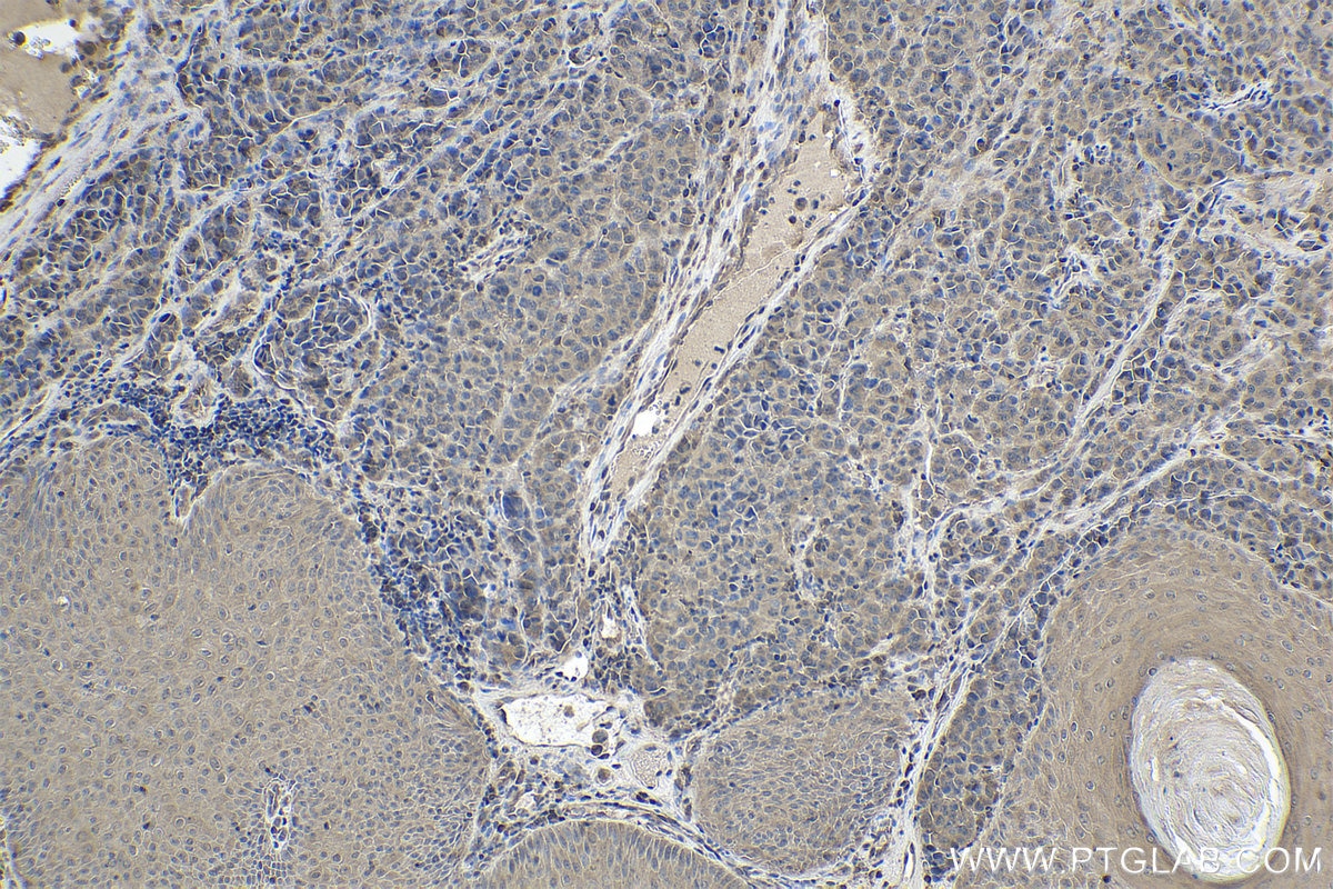 Immunohistochemical analysis of paraffin-embedded human malignant melanoma tissue slide using KHC1902 (INPP5K IHC Kit).