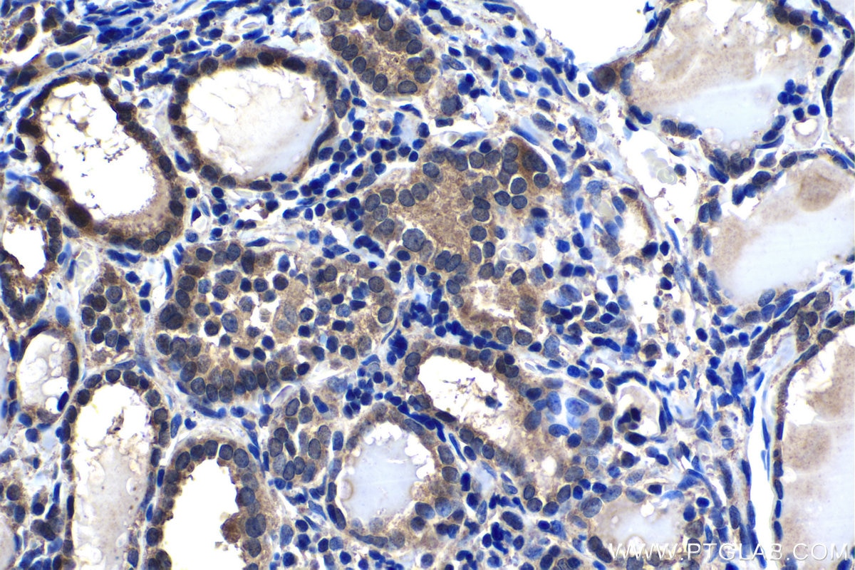 Immunohistochemical analysis of paraffin-embedded human thyroid cancer tissue slide using KHC1444 (INPPL1 IHC Kit).
